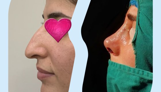 Rhinoplasty Surgery Result  - Before & After