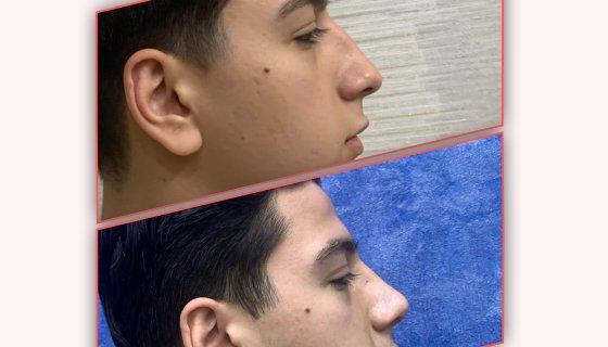 Rhinoplasty Result - 1 Week after Surgery