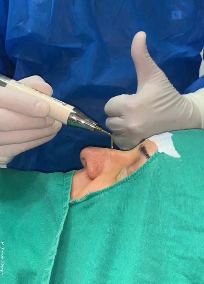 Ultrasonic Rhinoplasty