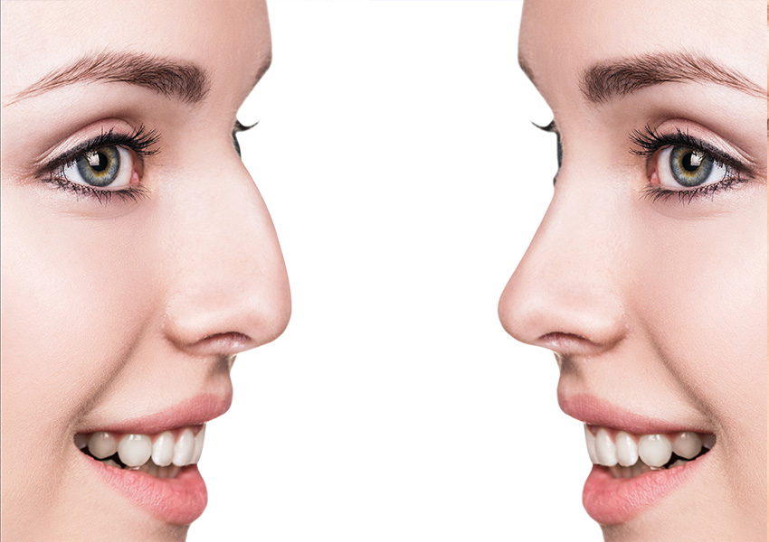 Rhinoplasty