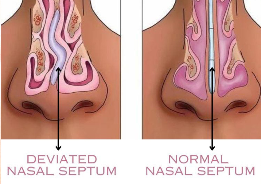 Septoplasty