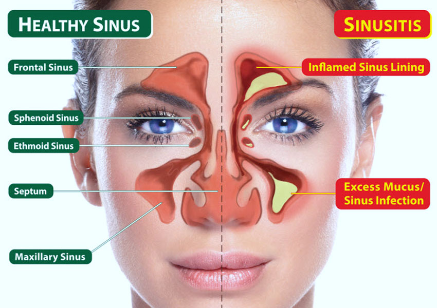 Sinusitis