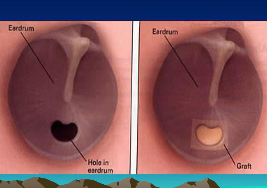 Myringoplasty 