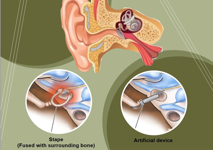 Stapedectomy