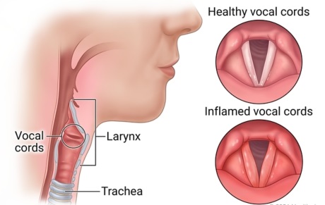 Direct Laryngoscopy