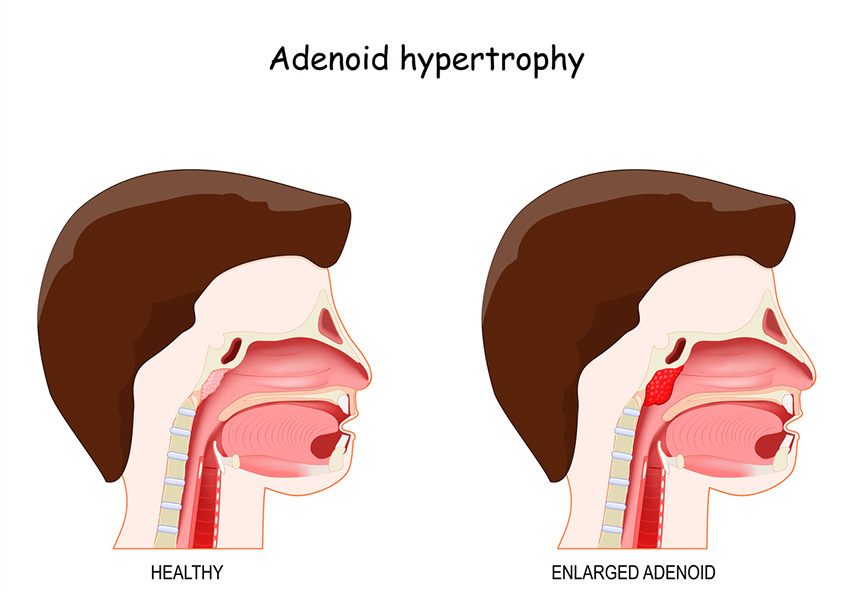 Adenoidectomy