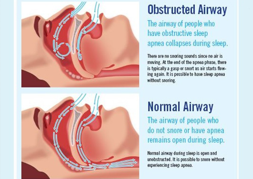 Snoring Surgery