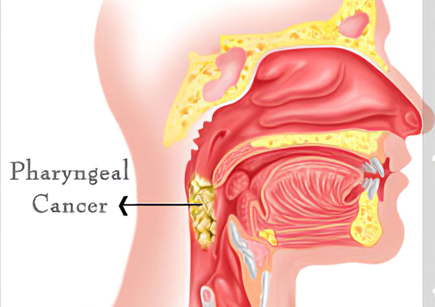 Throat Cancer Surgery