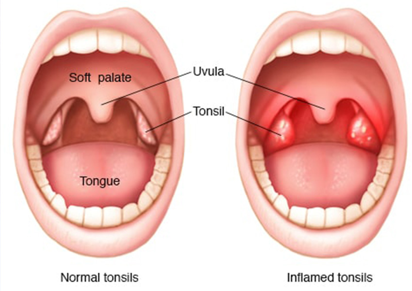 Tonsillectomy