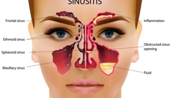 SINUSITIS SURGERY